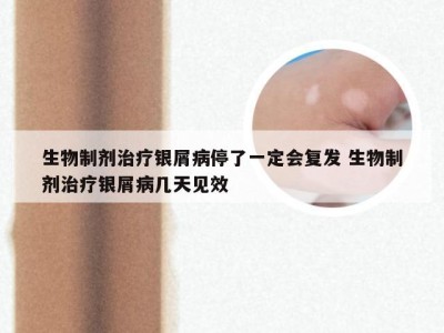 生物制剂治疗银屑病停了一定会复发 生物制剂治疗银屑病几天见效