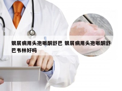 银屑病用头孢哌酮舒巴 银屑病用头孢哌酮舒巴韦林好吗