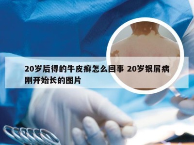 20岁后得的牛皮癣怎么回事 20岁银屑病刚开始长的图片