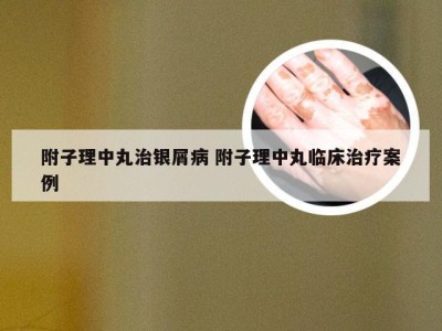 附子理中丸治银屑病 附子理中丸临床治疗案例