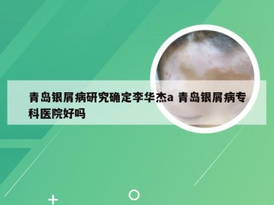 青岛银屑病研究确定李华杰a 青岛银屑病专科医院好吗