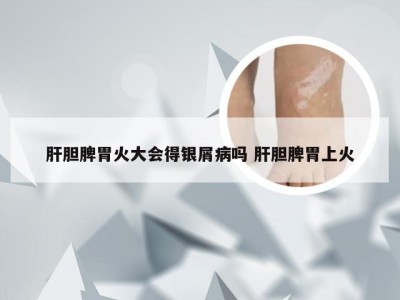 肝胆脾胃火大会得银屑病吗 肝胆脾胃上火