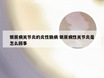 银屑病关节炎的炎性肠病 银屑病性关节炎是怎么回事