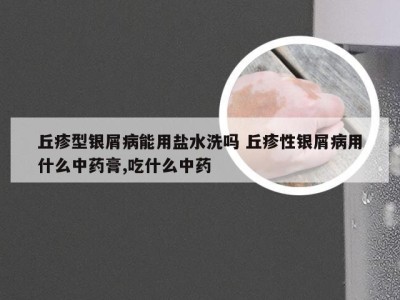 丘疹型银屑病能用盐水洗吗 丘疹性银屑病用什么中药膏,吃什么中药