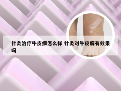 针灸治疗牛皮癣怎么样 针灸对牛皮癣有效果吗