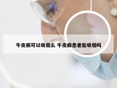 牛皮癣可以吸烟么 牛皮癣患者能吸烟吗