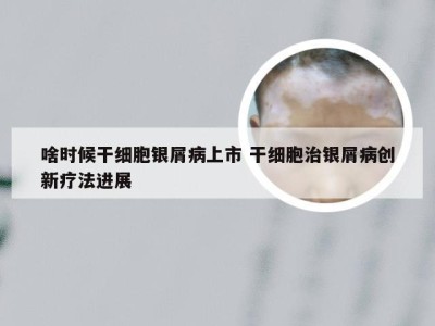 啥时候干细胞银屑病上市 干细胞治银屑病创新疗法进展