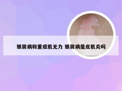 银屑病和重症肌无力 银屑病是皮肌炎吗