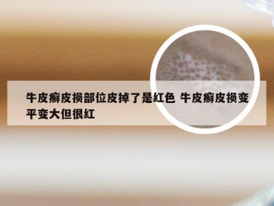 牛皮癣皮损部位皮掉了是红色 牛皮癣皮损变平变大但很红