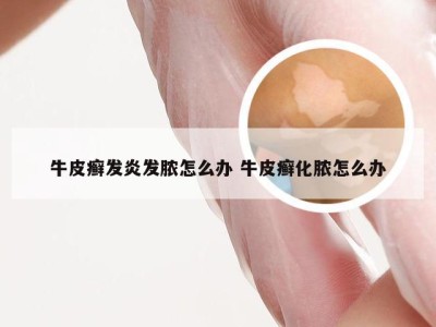 牛皮癣发炎发脓怎么办 牛皮癣化脓怎么办