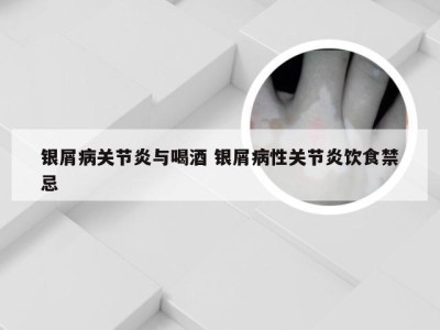 银屑病关节炎与喝酒 银屑病性关节炎饮食禁忌