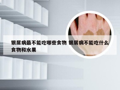 银屑病最不能吃哪些食物 银屑病不能吃什么食物和水果