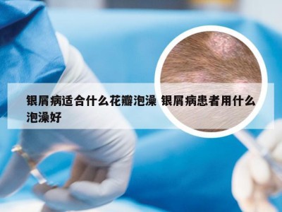 银屑病适合什么花瓣泡澡 银屑病患者用什么泡澡好