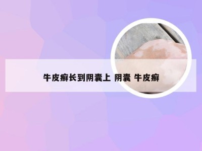 牛皮癣长到阴囊上 阴囊 牛皮癣