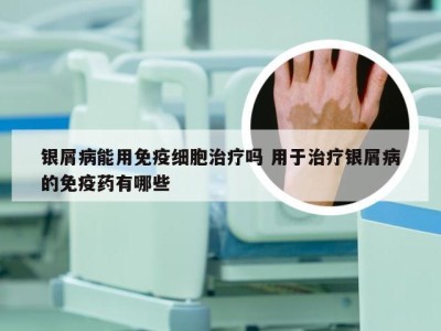 银屑病能用免疫细胞治疗吗 用于治疗银屑病的免疫药有哪些