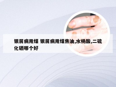 银屑病用煤 银屑病用煤焦油,水杨酸,二硫化硒哪个好