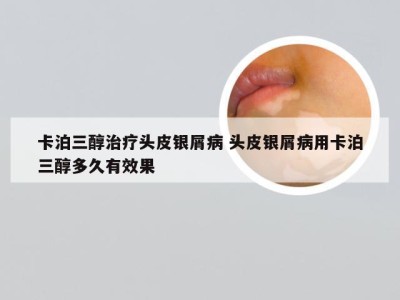 卡泊三醇治疗头皮银屑病 头皮银屑病用卡泊三醇多久有效果