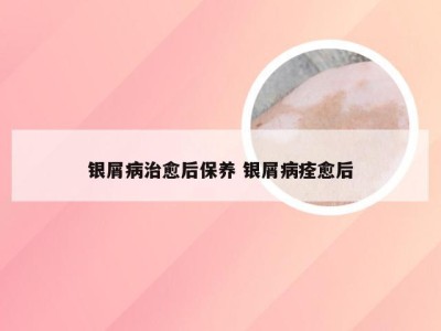 银屑病治愈后保养 银屑病痊愈后