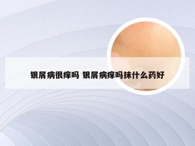 银屑病很痒吗 银屑病痒吗抹什么药好