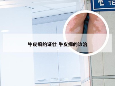 牛皮癣的证壮 牛皮癣的诊治