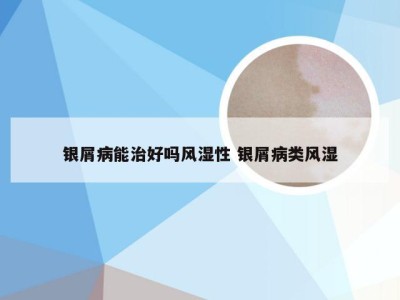 银屑病能治好吗风湿性 银屑病类风湿