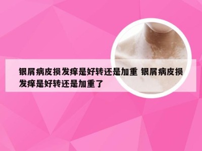 银屑病皮损发痒是好转还是加重 银屑病皮损发痒是好转还是加重了