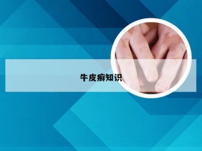 牛皮癣知识