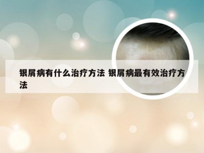 银屑病有什么治疗方法 银屑病最有效治疗方法
