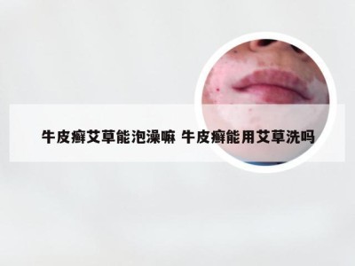 牛皮癣艾草能泡澡嘛 牛皮癣能用艾草洗吗