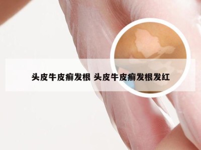 头皮牛皮癣发根 头皮牛皮癣发根发红