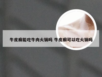 牛皮癣能吃牛肉火锅吗 牛皮癣可以吃火锅吗