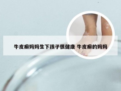 牛皮癣妈妈生下孩子很健康 牛皮癣的妈妈