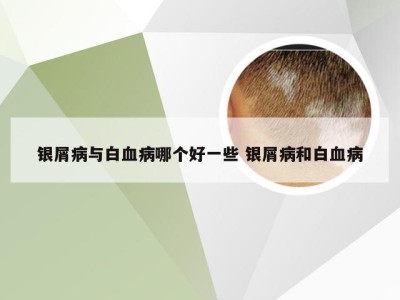 银屑病与白血病哪个好一些 银屑病和白血病