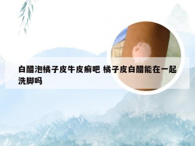 白醋泡橘子皮牛皮癣吧 橘子皮白醋能在一起洗脚吗