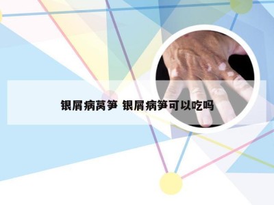 银屑病莴笋 银屑病笋可以吃吗