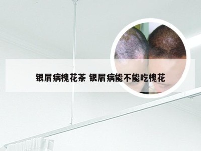 银屑病槐花茶 银屑病能不能吃槐花