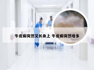 牛皮癣突然又长身上 牛皮癣突然增多