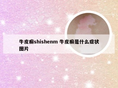 牛皮癣shishenm 牛皮癣是什么症状图片