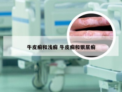 牛皮癣和浅癣 牛皮癣和银屑癣
