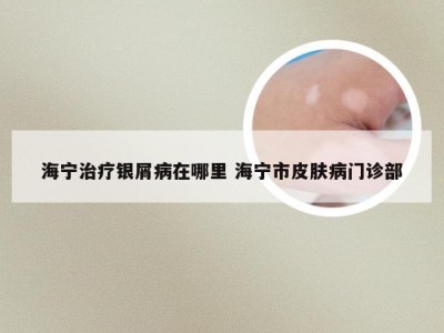 海宁治疗银屑病在哪里 海宁市皮肤病门诊部