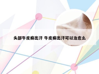 头部牛皮癣出汗 牛皮癣出汗可以治愈么