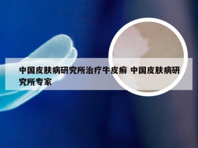 中国皮肤病研究所治疗牛皮癣 中国皮肤病研究所专家