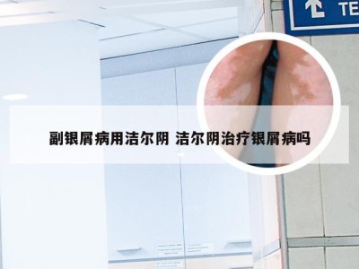 副银屑病用洁尔阴 洁尔阴治疗银屑病吗