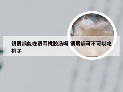 银屑病能吃银耳桃胶汤吗 银屑病可不可以吃桃子