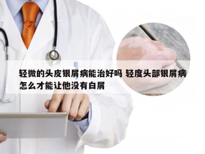 轻微的头皮银屑病能治好吗 轻度头部银屑病怎么才能让他没有白屑