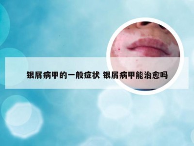 银屑病甲的一般症状 银屑病甲能治愈吗