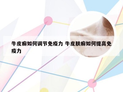 牛皮癣如何调节免疫力 牛皮肤癣如何提高免疫力