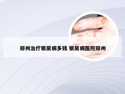 郑州治疗银屑病多钱 银屑病医院郑州