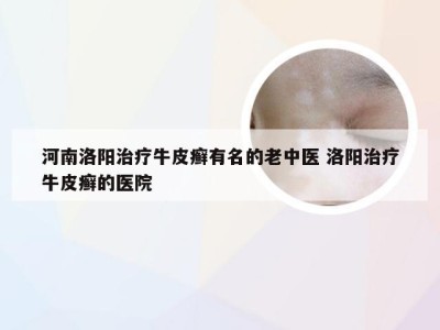 河南洛阳治疗牛皮癣有名的老中医 洛阳治疗牛皮癣的医院