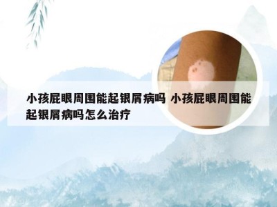 小孩屁眼周围能起银屑病吗 小孩屁眼周围能起银屑病吗怎么治疗